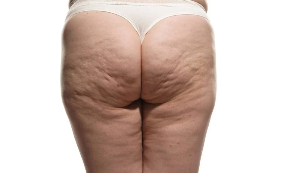 Pele do bumbum e pernas com aspecto frouxo ou flácido?